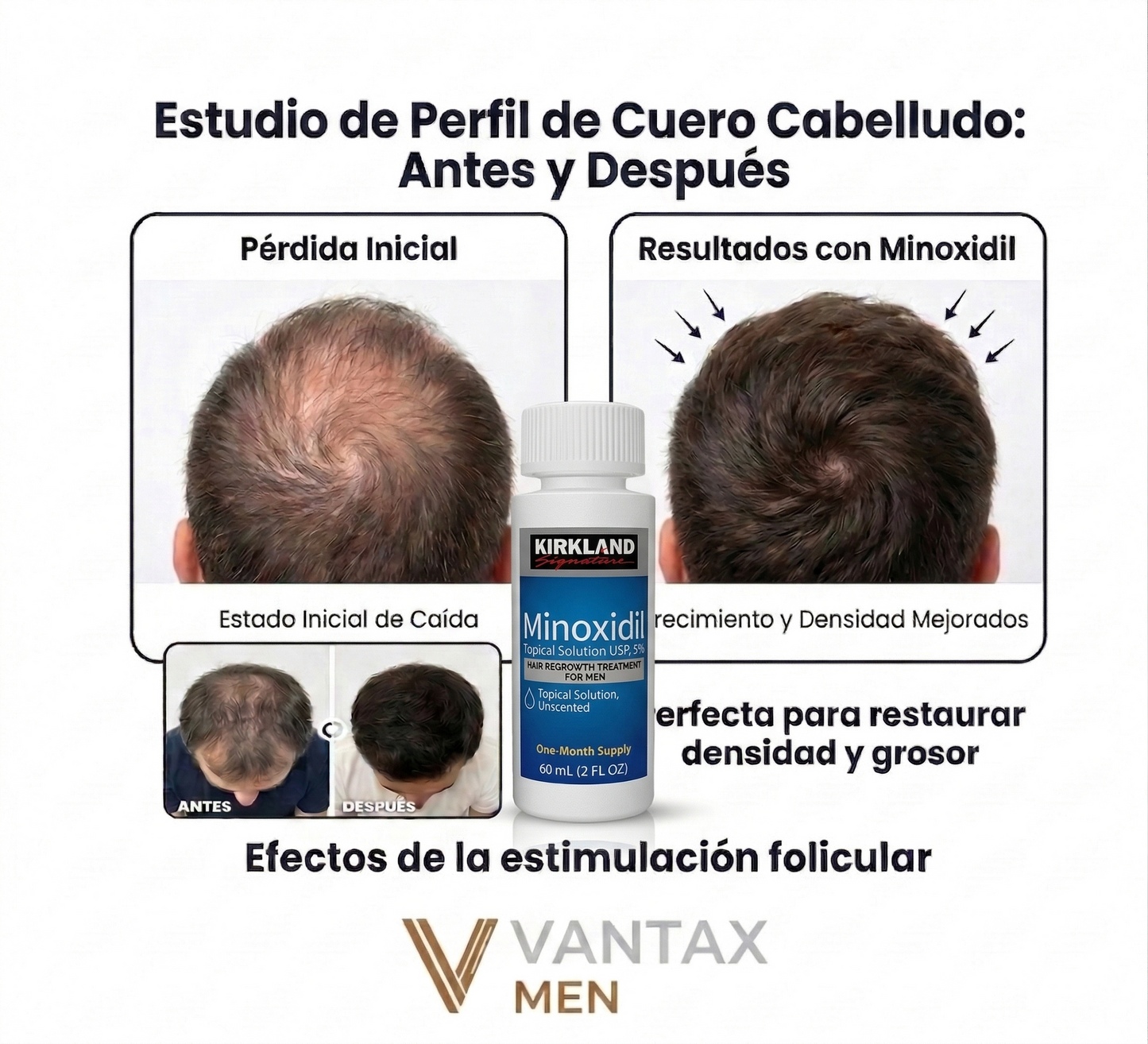 Minoxidil 5% Kirkland — 60ml + Gotero | Tratamiento Capilar